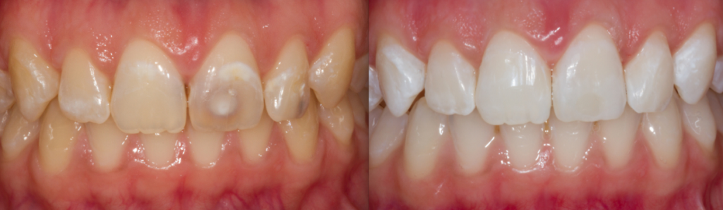 diş estetiği edirne