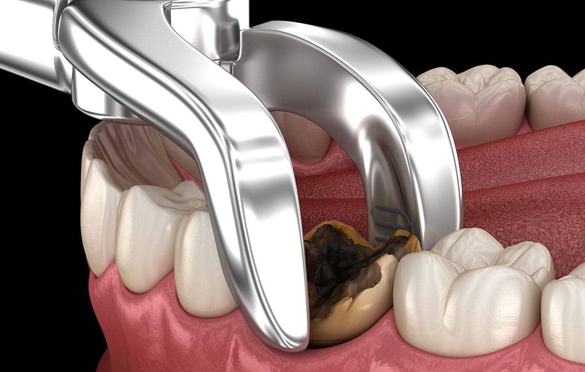 cerrahi diş çekimi edirne