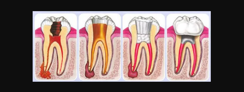 edirne çocuk dişi kanal tedasi