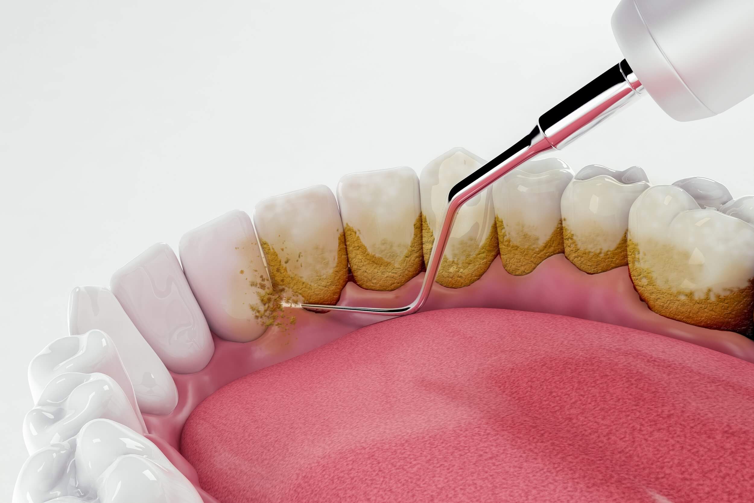 edirne diş taşı temizleme