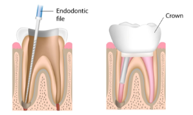 edirne kanal tedavisi