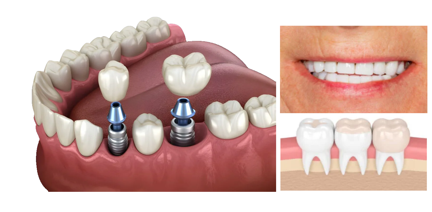 implant cerrahisi edirne