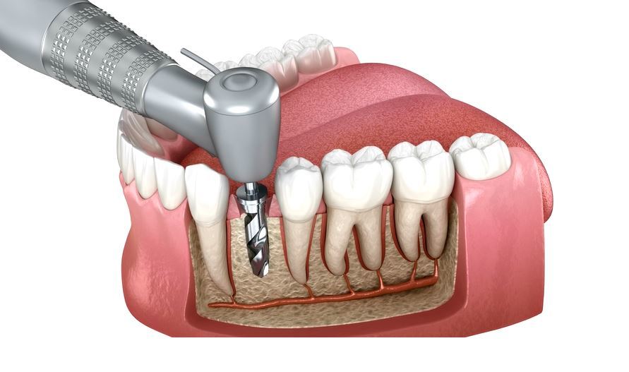 implant cerrahı edirne