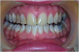 kompozit lamina diş edirne