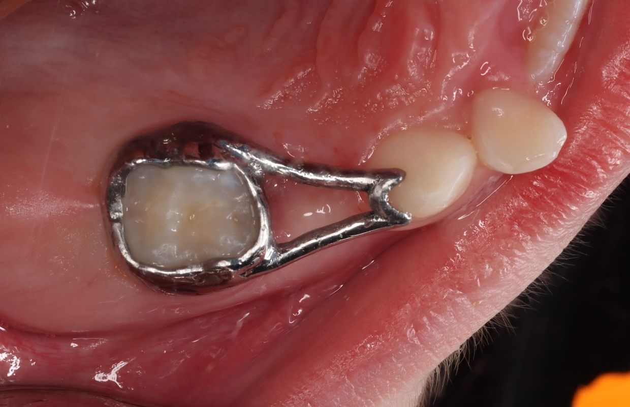 edirne süt diş çekimi