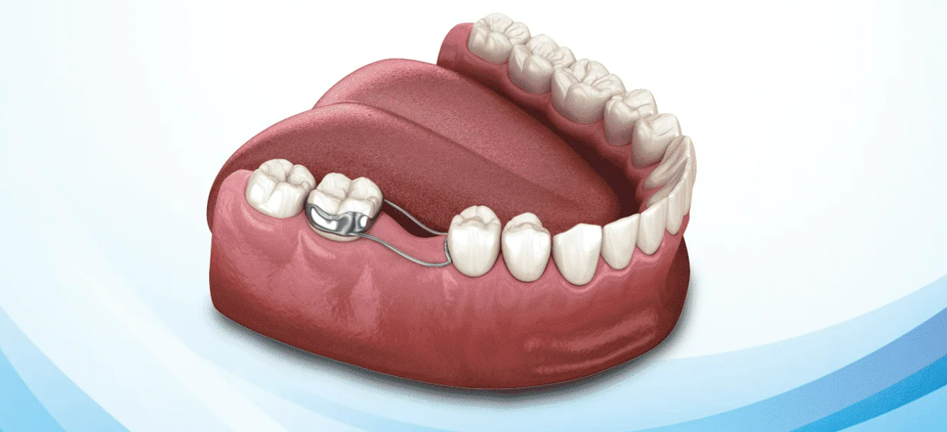 Yer tutucu diş köprüsü edirne